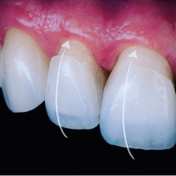 Lentes de Contato Dental em Santos - Solução Oral Odontologia