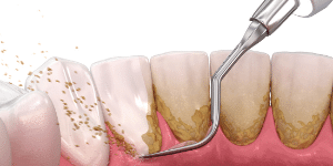 Periodontia em Santos - Ultrassom - Solução Oral odontologia